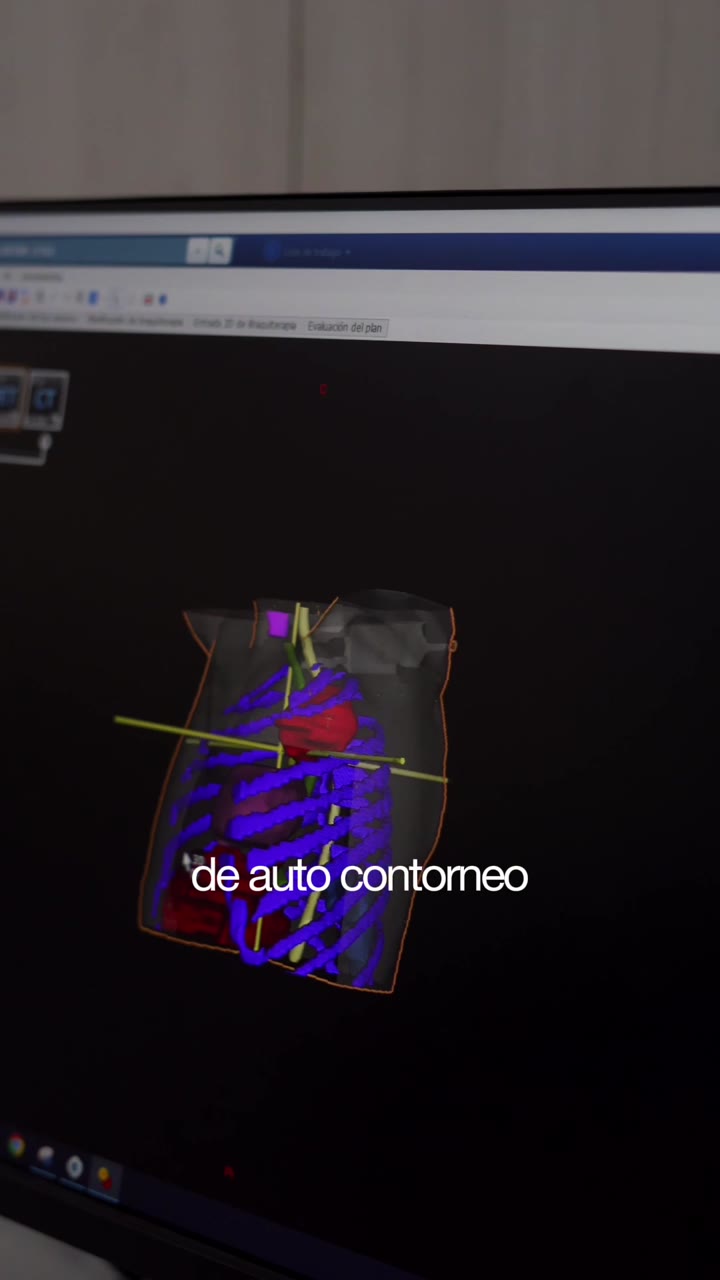 Planificación de radioterapia en el Centro Oncológico del Litoral